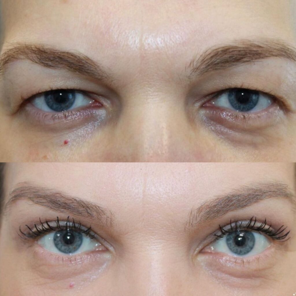 Dr. Murat Sağdık upper blepharoplasty