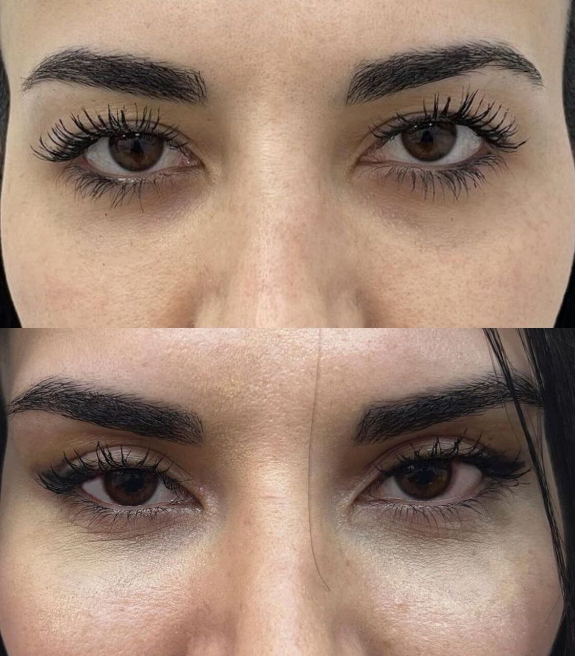 Almond Eyes - Dr. Murat Sağdık